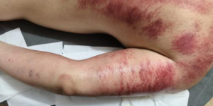 赵翌伊荣获拾遗传承“传统中医内病外治砭术诊疗法非物质文化遗产传承人”称号